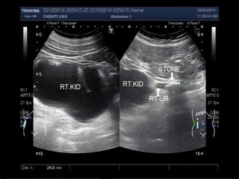 Ultrasound Video Showing A Large Ureteric Stone Renal Parenchymal