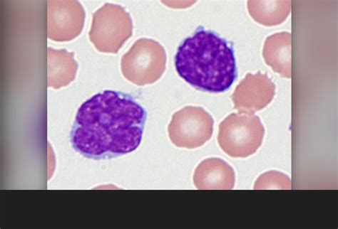 Mantle Cell Lymphoma: Diagnosis and Differentiation