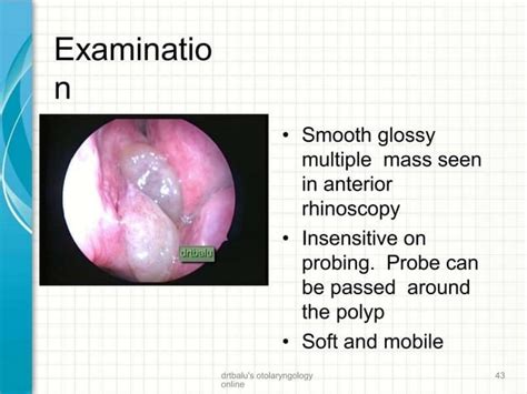 Nasal Polyps Etiology Pathogenesis Clinical Features Management Ppt