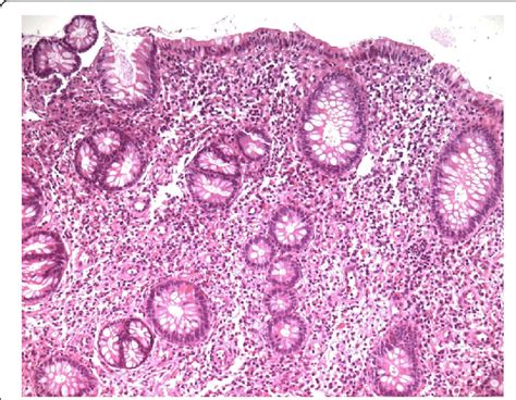 Ileocecal Junction Histology