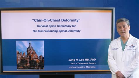 Cervical Spine Osteotomy For Chin On Chest Deformity Johns Hopkins