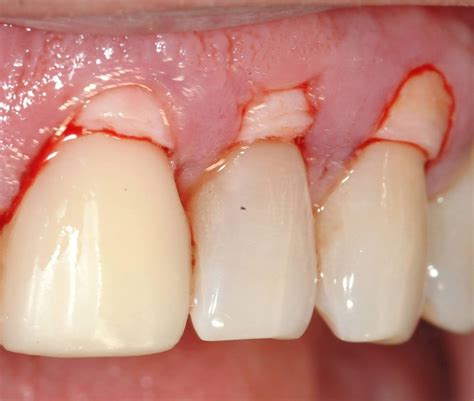 Periacryl Cirug A Mucogingival Dental Tonal