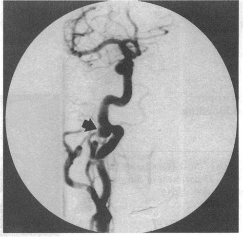 Arteriogram Showing Aneurism Of Right Internal Carotid Artery At Skull Download Scientific