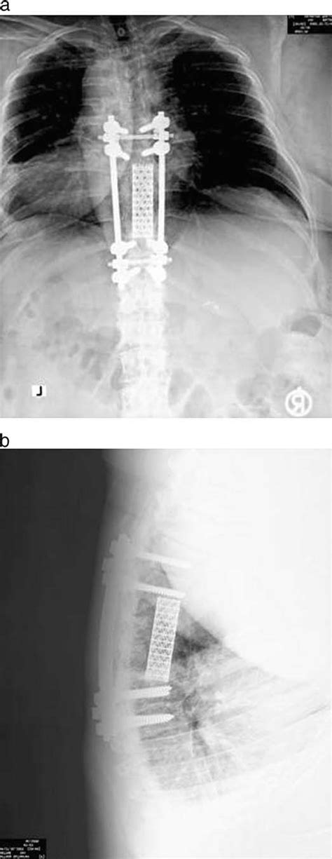 Postoperative Anteroposterior A And Lateral B Radiographs Of This