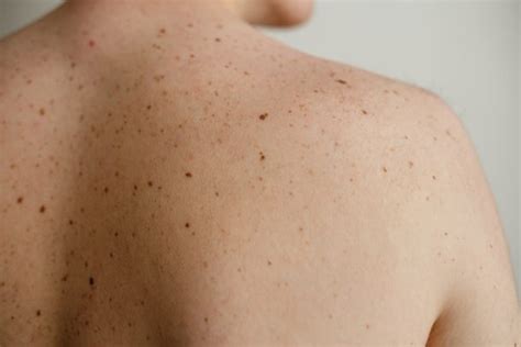 When to Be Concerned About Mole (And See a Dermatologist)