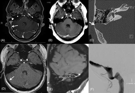 Figure Examples Of Sinus Stenosis And Typical Associated Findings A Download Scientific