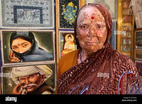 Tree Bark Skin Disorder