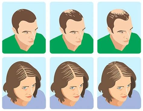 Androgenic Alopecia Aka Male And Female Pattern Baldness