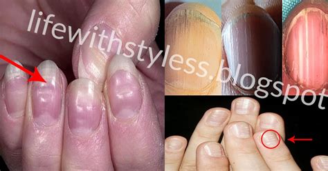 Health Warnings Your Fingernails May Be Sending Life With Styles