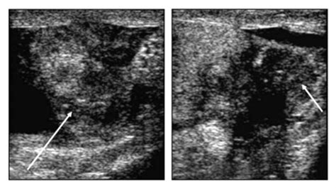 Benign And Malignant Epididymal Masses Evaluated With Scrotal