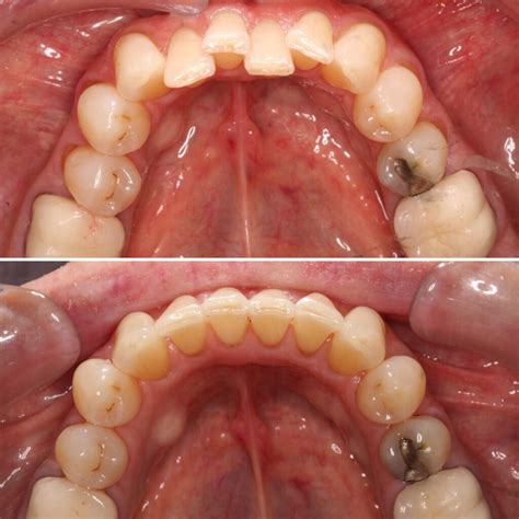 Crowding Teeth Before And After