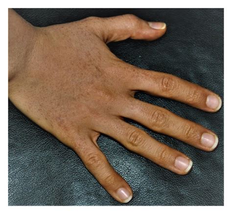 Multiple Erythematous Flat Topped Papules Located On Dorsal Areas Of Download Scientific