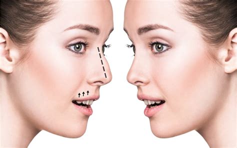 How To Achieve The Perfect Nose Rhinoplasty Surgery