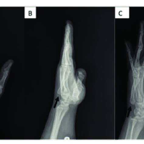 A Ap B Lateral And C Oblique Radiographs Of The Second Arrival At Download Scientific