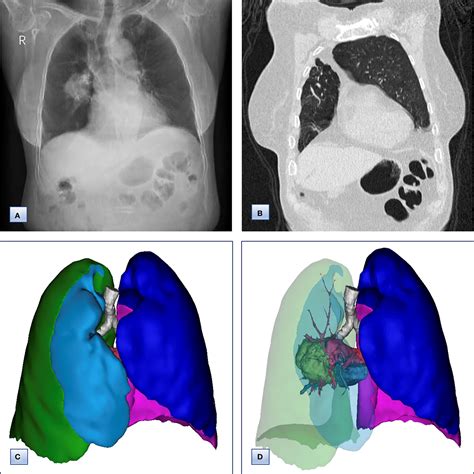 Frontiers Lung Adenocarcinoma Concurrent With Congenital Pulmonary