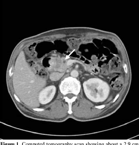 Figure 1 From A Case Of Afferent Loop Syndrome Treated By Endoscopic Metal Stent Insertion Using