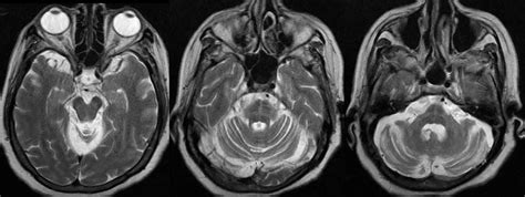Neuroradiology Cases: Multiple System Atrophy MRI