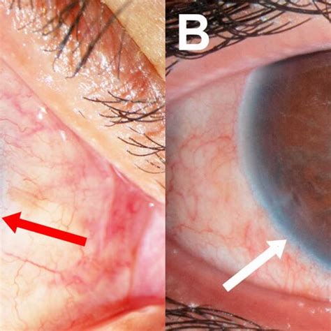 Case Two A Initial Presentation With Spontaneous Hyphema And