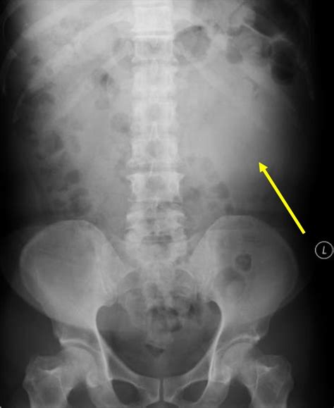 Renal Cell Carcinoma Radiology Cases