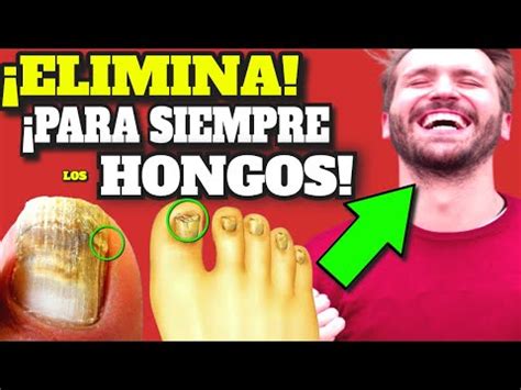 Descubre El Mejor Tratamiento Para Hongos En Las U As