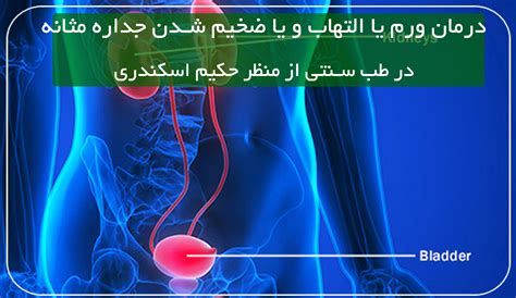 مقالات بیماریهای پروستات و مثانه در طب سنتی حکیم اسکندری درمان با