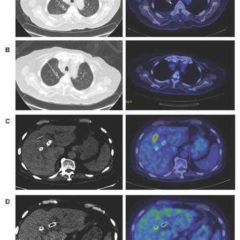 Resolution Of Liver And Lung Metastasis In The Patient After Commencing Download Scientific