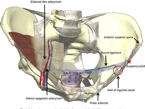 Figure From A New Laparoscopic Technique Of Inguinal Ligament