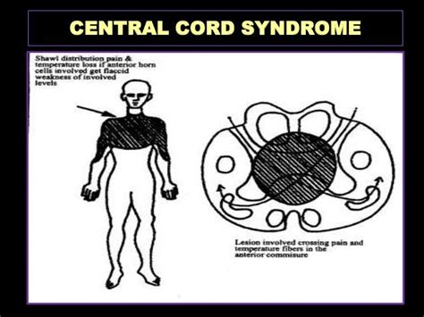 Spinal Cord Syndromes