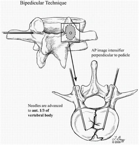 Vertebroplasty And Kyphoplasty Radiology Key