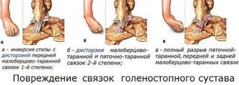 Растяжения связок голеностопа: лечение в домашних условиях