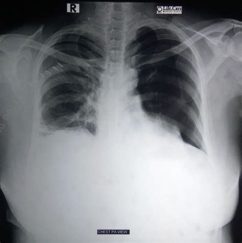 Catamenial Pneumothorax A Rare Diagnosis Eurorad