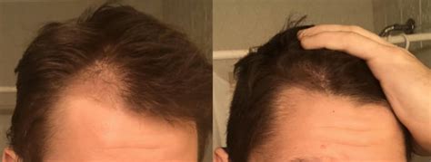 Finasteride Journey Updated Added Minox Tressless