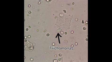 Vaginal Smear Trichomonas Test In Lab Vaginal Swab Trichomoniasis Under Micriscop Youtube