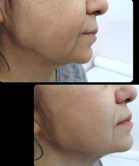 HIFU Facelift Before And After (4) » Facelift: Info, Prices, Photos ...