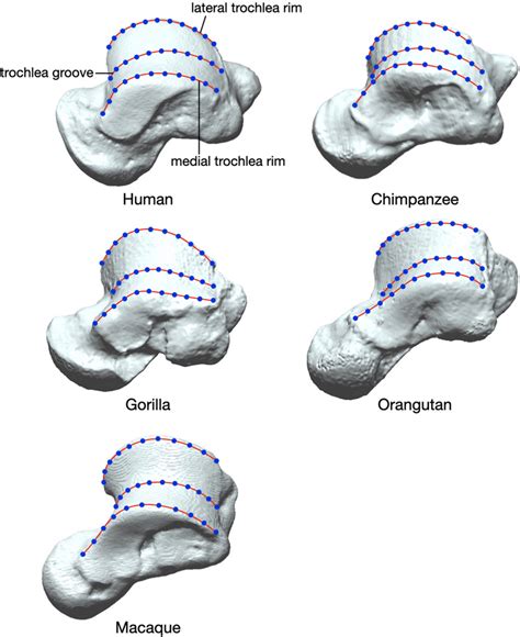 The Medial And Lateral Trochlea Rims And The Trochlea Groove Red