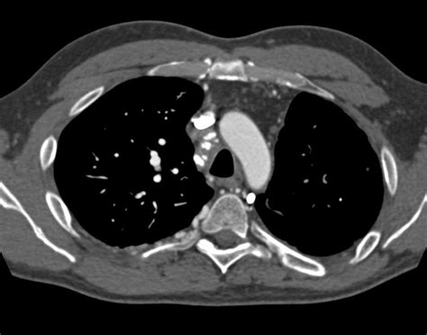 Superior Vena Cava Svc Occlusion With Mediastinal Varices Chest