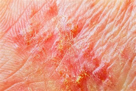 What Does Eczema Look Like 5 Signs To Never Ignore Reader S Digest