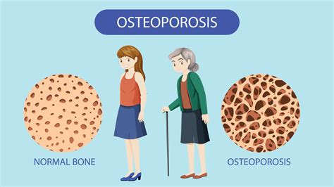 2019 Endocrine Society Guidelines Postmenopausal Osteoporosis