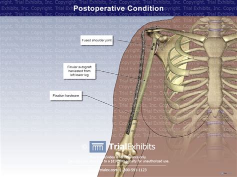 Postoperative Condition Trial Exhibits Inc