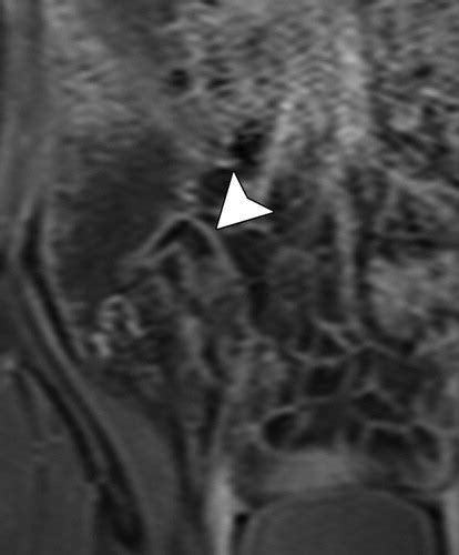 Rose Thorn Ulcers Radiology Plant Thorn Arthritis Plant Thorn