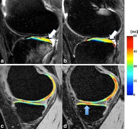 Quantitative Mri Of Articular Cartilage And Its Clinical Applications