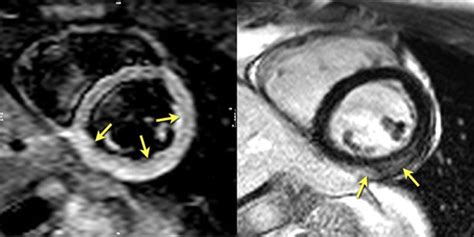 Myocarditis Mri Myocarditis Radiology Reference Article Radiopaedia