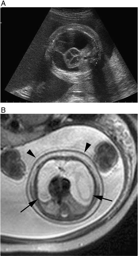 Successful Management Of A Large Fetal Mediastinal Teratoma Complicated