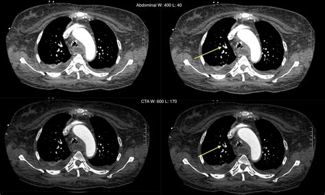 Study Search Patterns Evaluating For Pulmonary Embolus On A CT PE