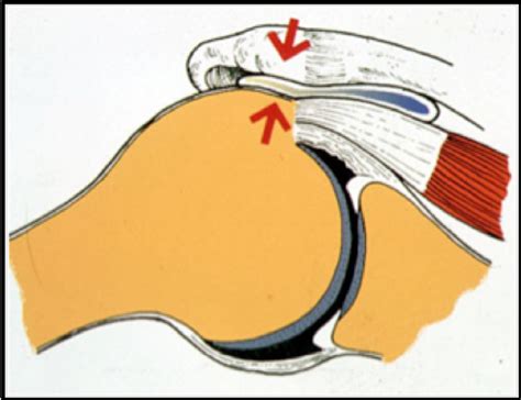 Rupture Centre Epaule Main De Besan On Chirurgie Orthop Dique Et