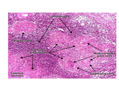 Granuloma Inflammation Powerpoint Presentation Ppt