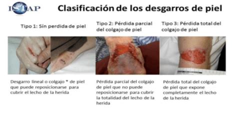 Desgarro Cut Neo La Piel Desgarrada Ap Sitos Para Heridas Polymem