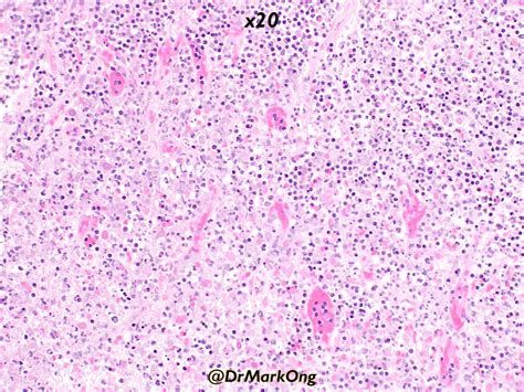 Jerad Gardner Md On Twitter Rt Drmarkong Lymph Node Biopsy Known