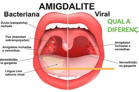 Amigdalite Viral O Que E Como Tratar