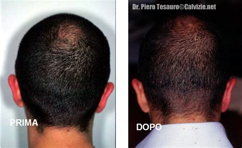 Trapianto Di Capelli Paura Della Cicatrice Calvizie Net